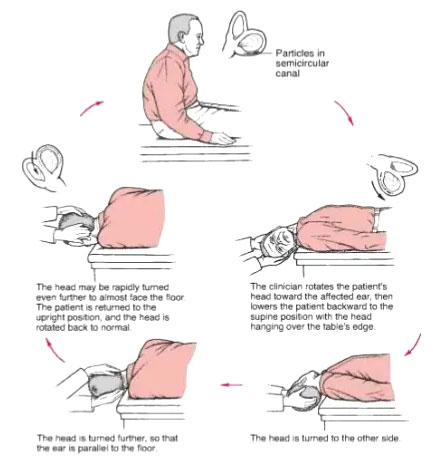 A Simple Visual Representation of Different Grades of AC Joint Injury 