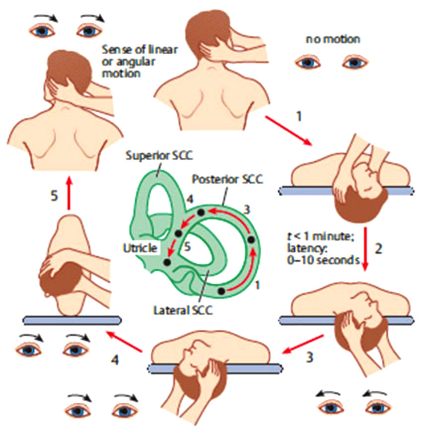 Figure 4 – A representation of what is happening to the crystals in the inner ear during an Epley Manoeuvre.