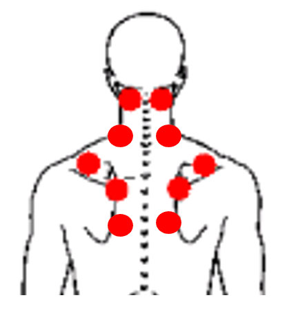 Figure 1 - Common Trigger Points associated with a Cervicogenic Headache 