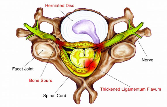 Figure 3 – Examples of some Acquired Factors Causing Stenosis