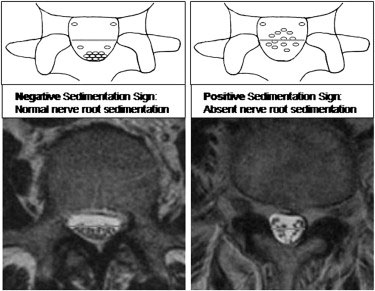 Figure 4 – Visual Representation and MRI scan showing the Nerve Root Sedimentation Sign indicating Stenosis. 