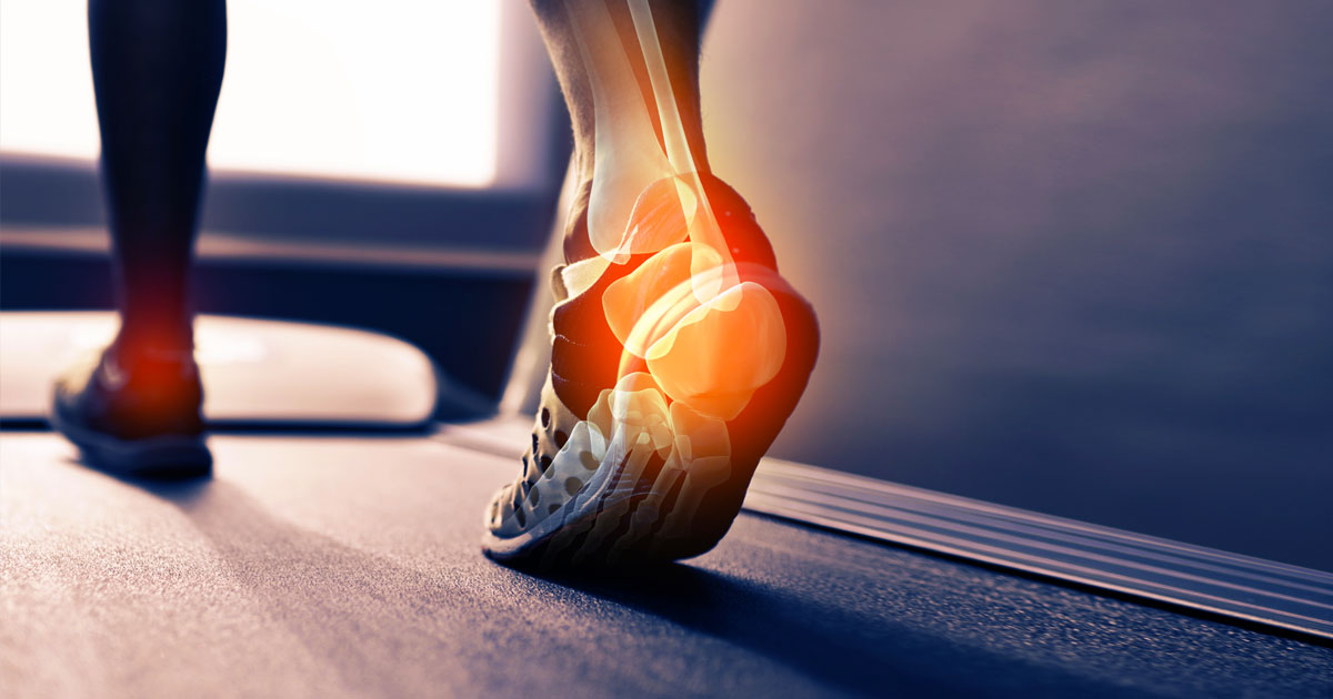 Plantar Fasciitis is the most common cause of heel pain seen in the community, affecting around 10% of the general population.