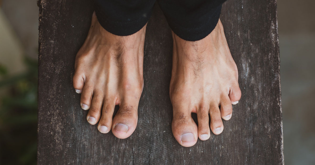A tear of the plantar plate can occur due to excessive strain or overload. Most commonly, tears develop in your second toe as that metatarsal is the longest which takes a load and increases the stress. 
