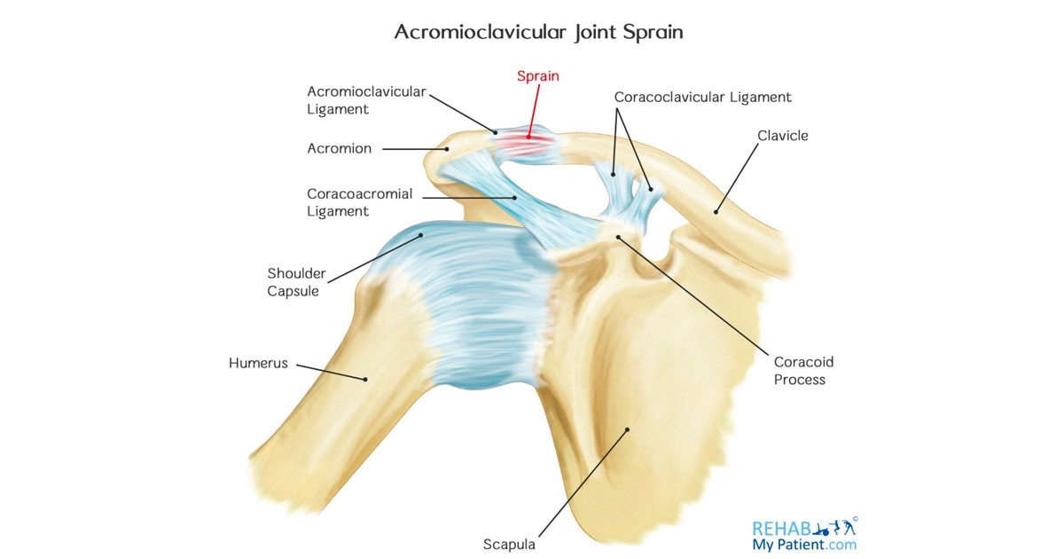 AC joint injuries account for 9-10% of all shoulder injuries. They are commonly injured by a traumatic force or by degeneration (less common). 