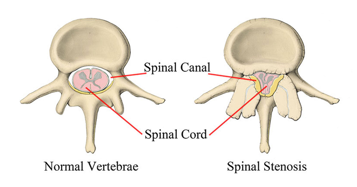 Lumbar stenosis means that the central spinal canal, which is the canal at the centre of the spine, is becoming narrowed. The spinal cord and other important blood vessel structures are contained within this canal. 